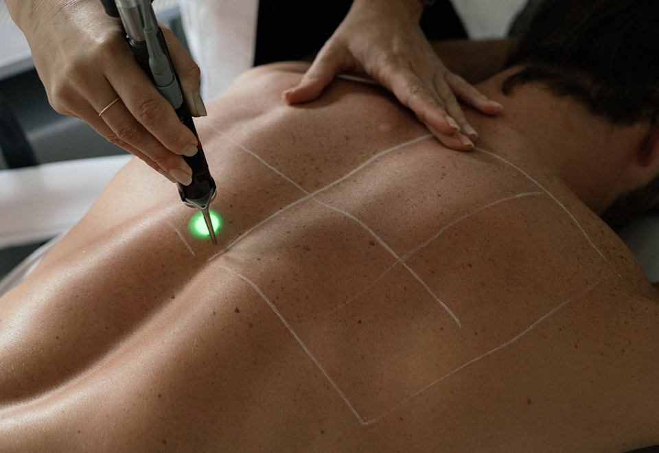 back laser hair removal