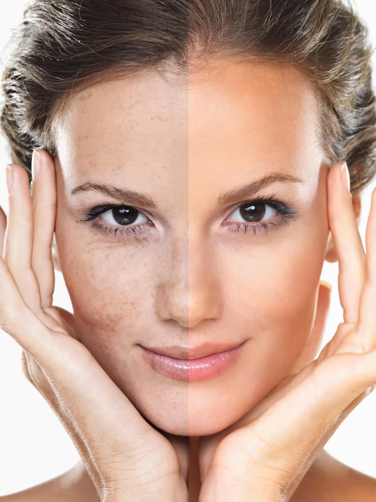 Woman's face “before” and “after” the laser procedure